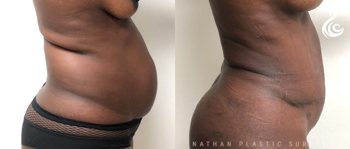 Tummy Tuck Before & After Gallery - Patient 245224 - Image 3