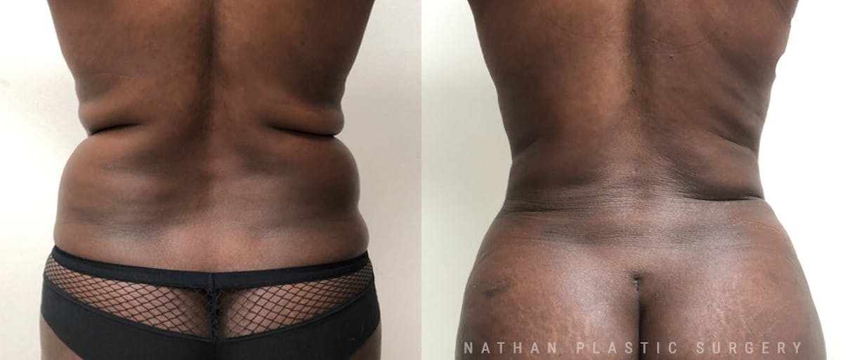 Tummy Tuck Before & After Gallery - Patient 245224 - Image 4
