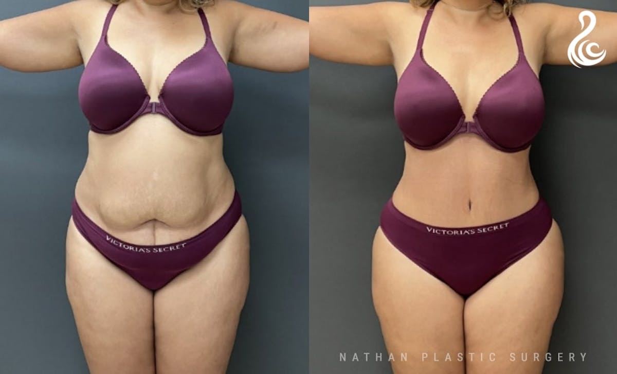 Tummy Tuck Before & After Gallery - Patient 418654 - Image 1