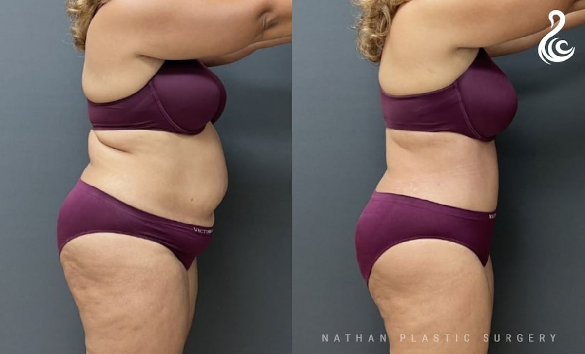 Tummy Tuck Before & After Gallery - Patient 418654 - Image 2