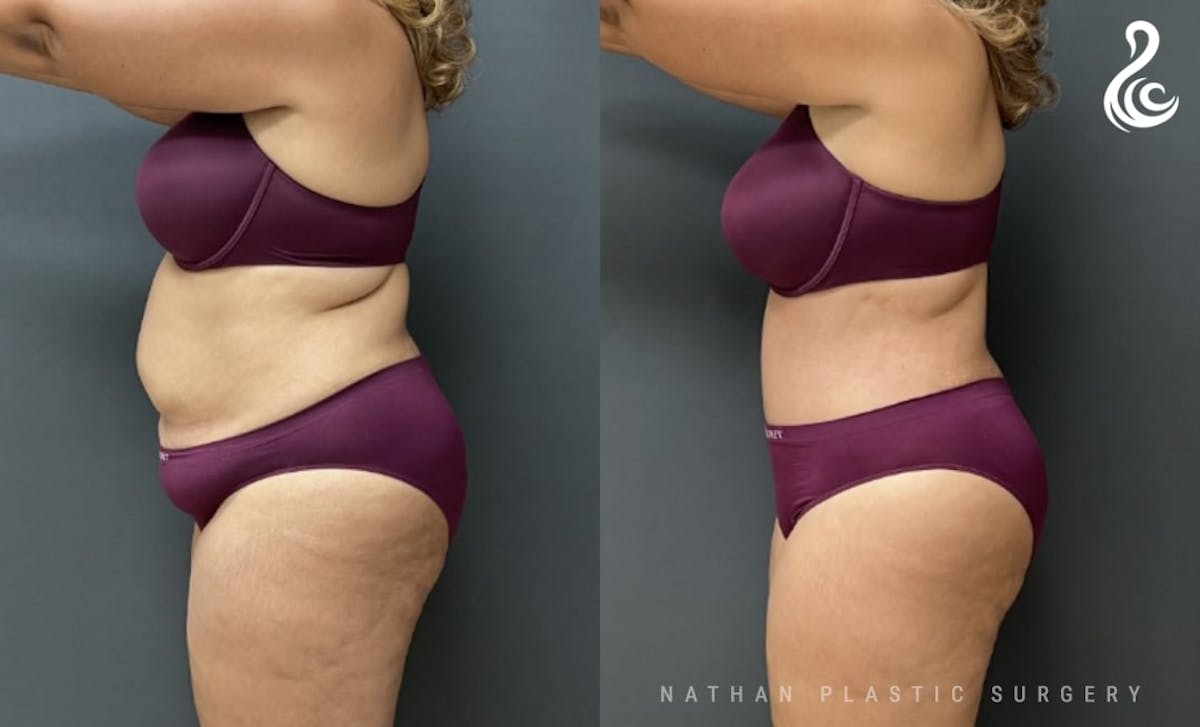 Tummy Tuck Before & After Gallery - Patient 418654 - Image 3