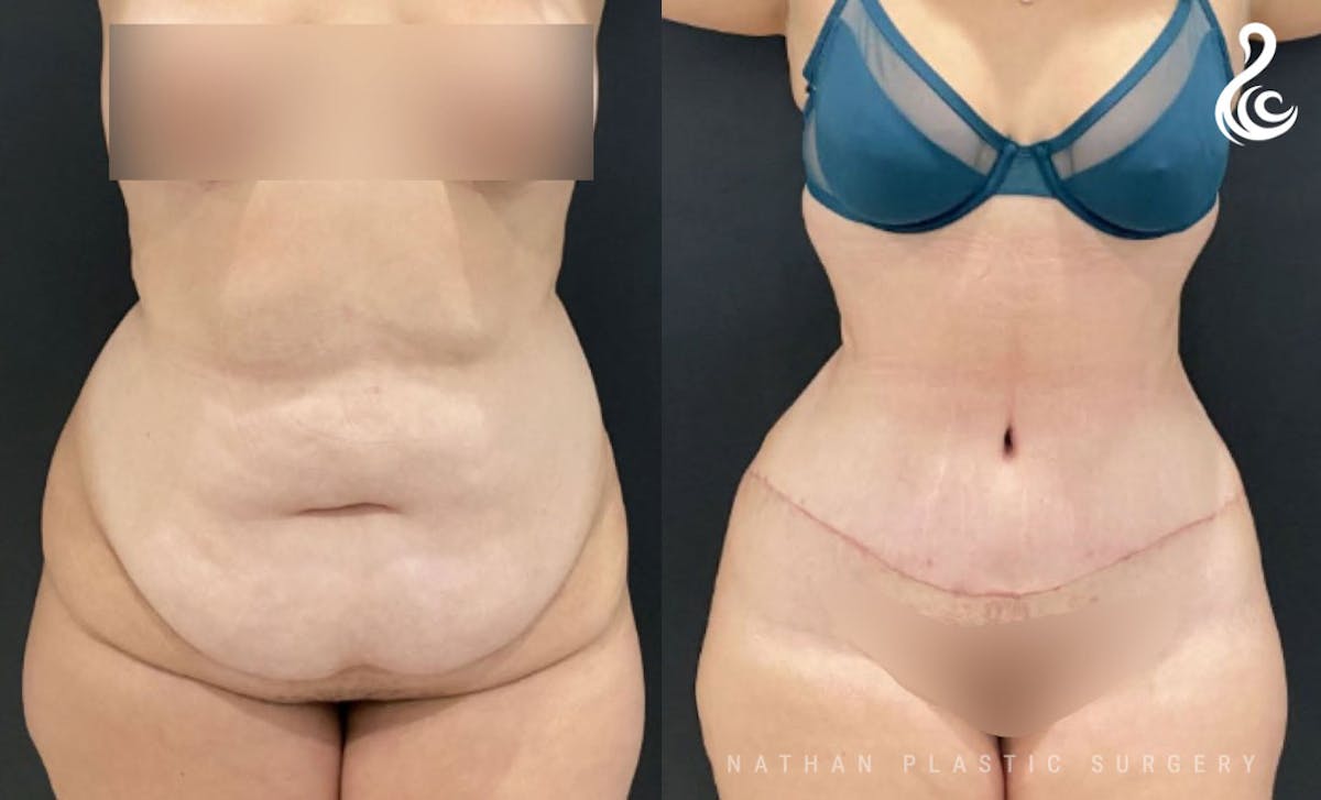 Tummy Tuck Before & After Gallery - Patient 276971 - Image 1