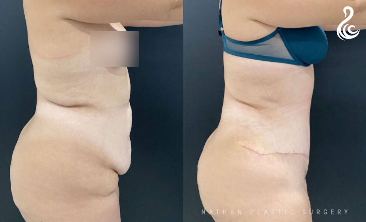 Tummy Tuck Before & After Gallery - Patient 276971 - Image 2