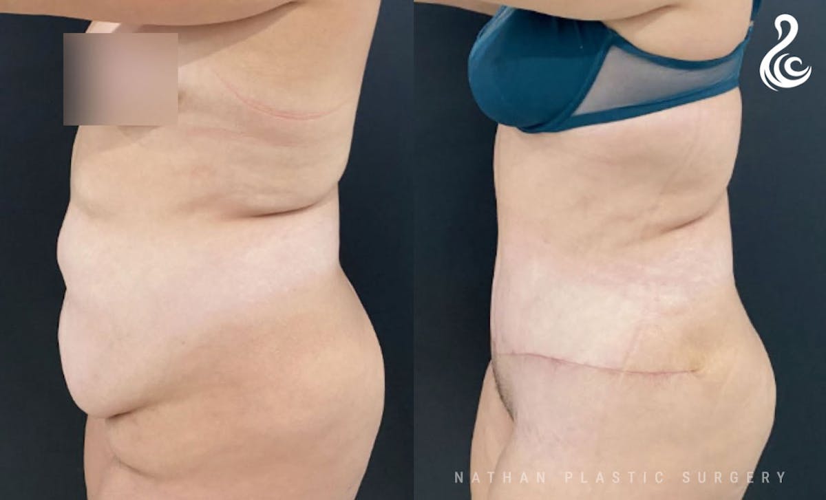 Tummy Tuck Before & After Gallery - Patient 276971 - Image 3