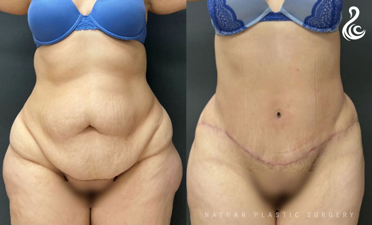 Tummy Tuck Before & After Gallery - Patient 421340 - Image 1