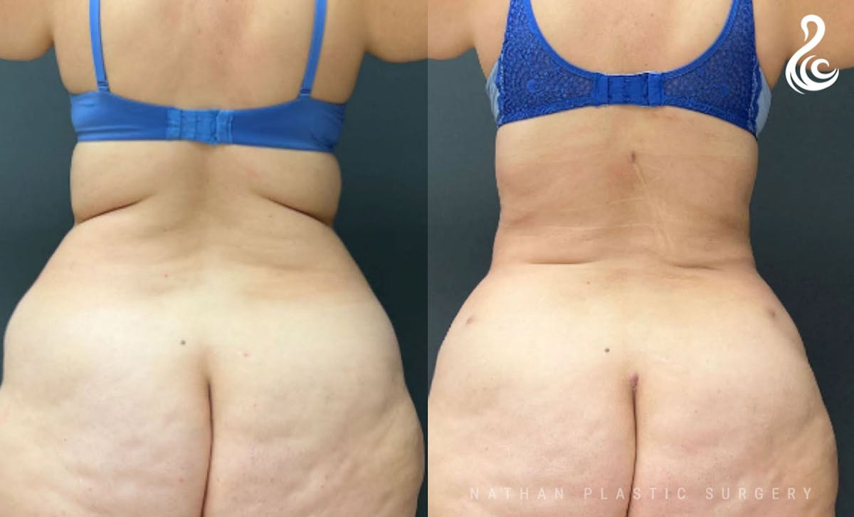 Tummy Tuck Before & After Gallery - Patient 421340 - Image 2