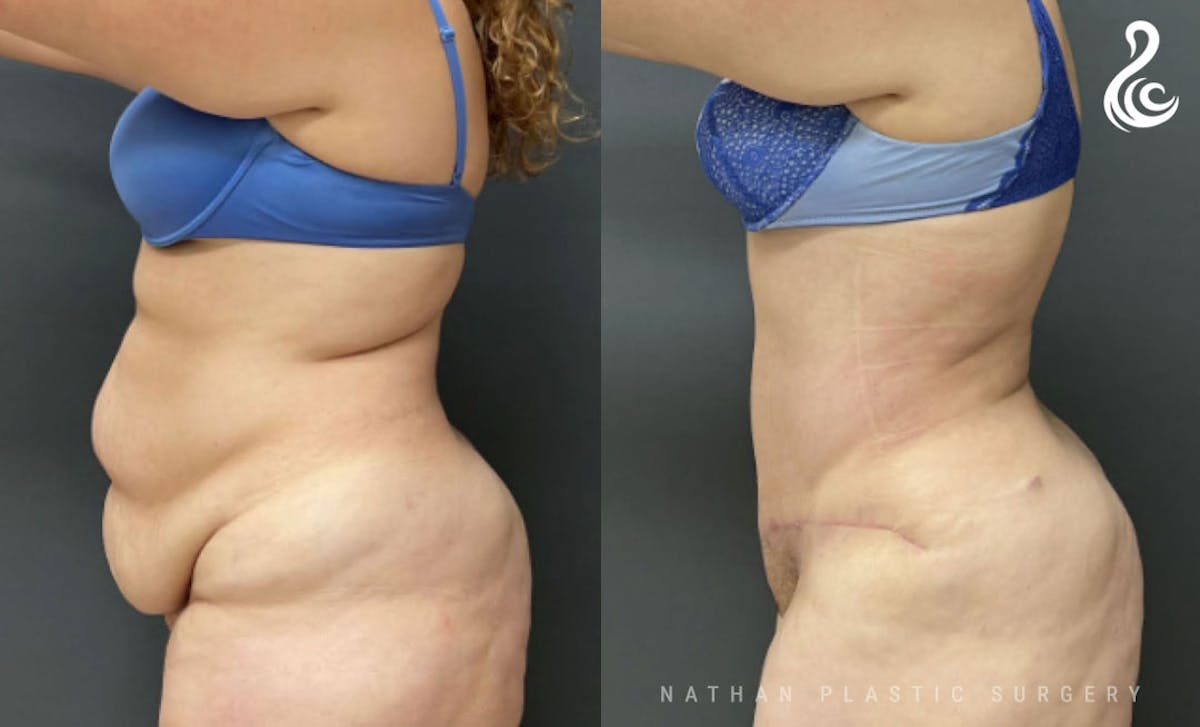 Tummy Tuck Before & After Gallery - Patient 421340 - Image 4