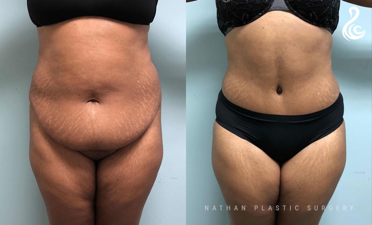 Tummy Tuck Before & After Gallery - Patient 943750 - Image 1