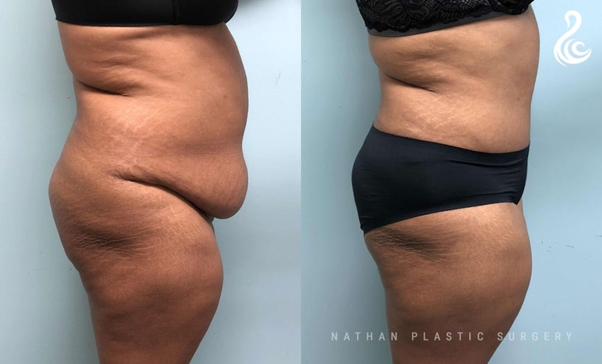 Tummy Tuck Before & After Gallery - Patient 943750 - Image 2