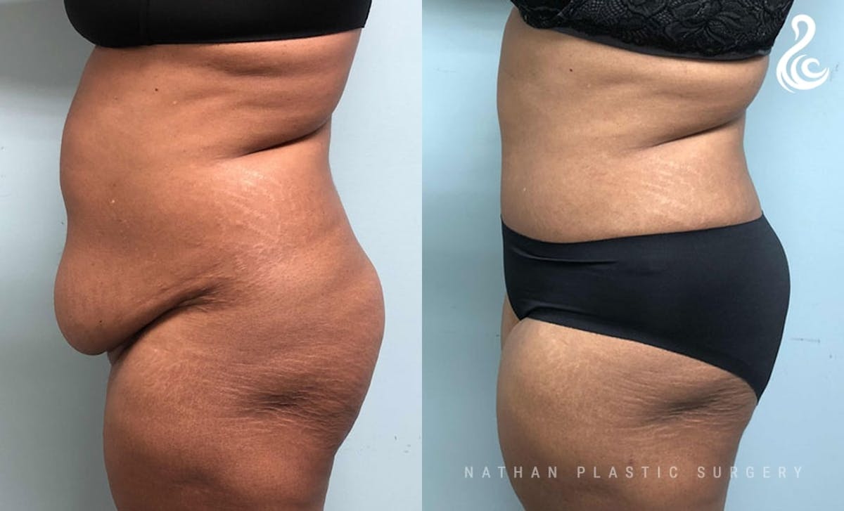 Tummy Tuck Before & After Gallery - Patient 943750 - Image 3