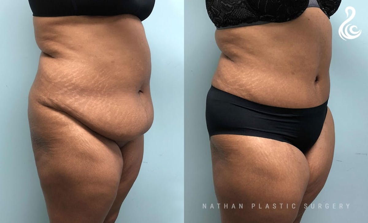 Tummy Tuck Before & After Gallery - Patient 943750 - Image 4