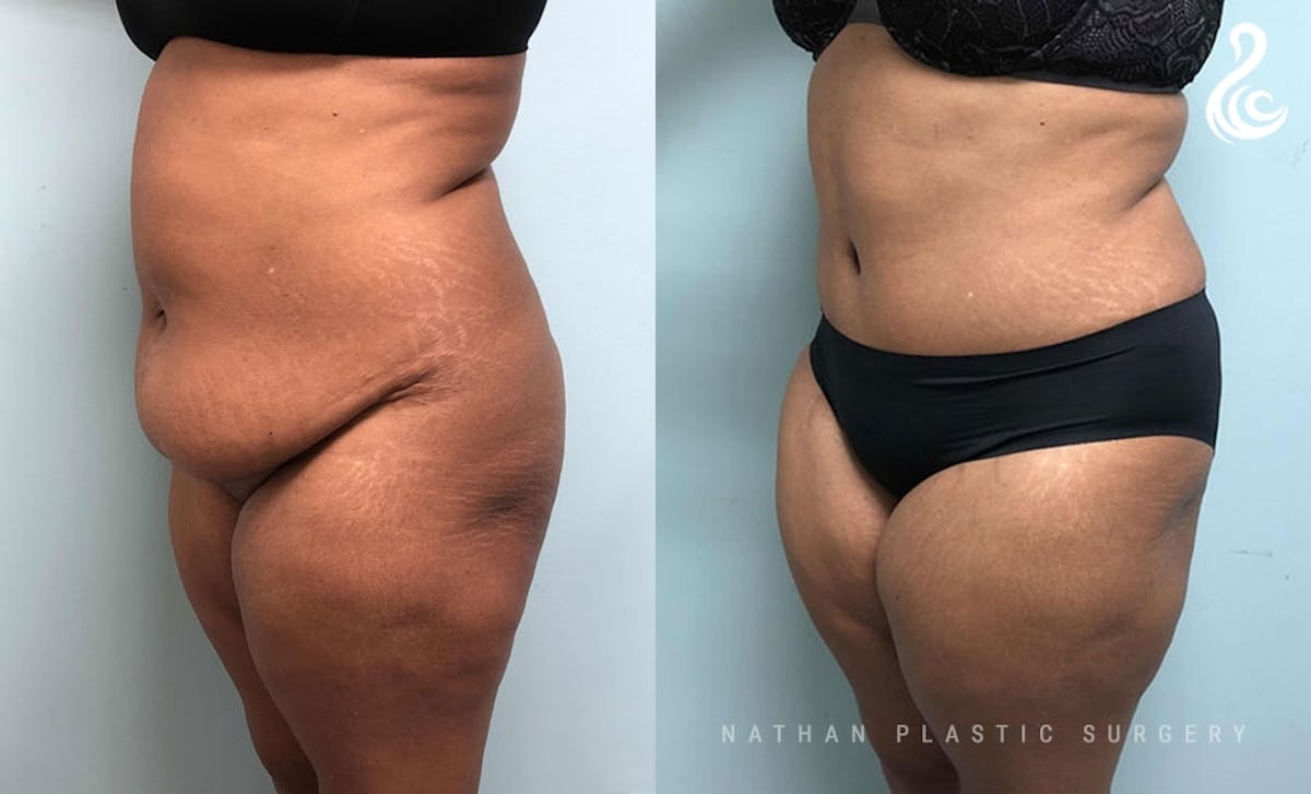 Tummy Tuck Before & After Gallery - Patient 943750 - Image 5