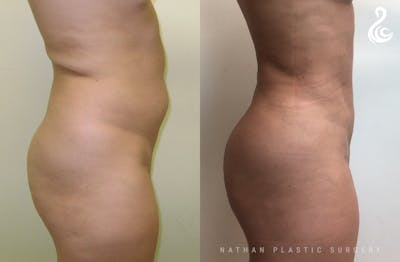 Liposuction Before & After Gallery - Patient 384405 - Image 1