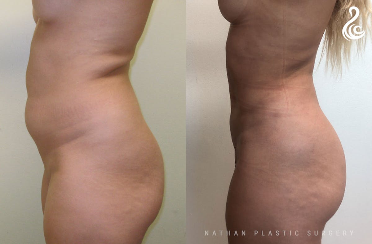 Liposuction Before & After Gallery - Patient 384405 - Image 2