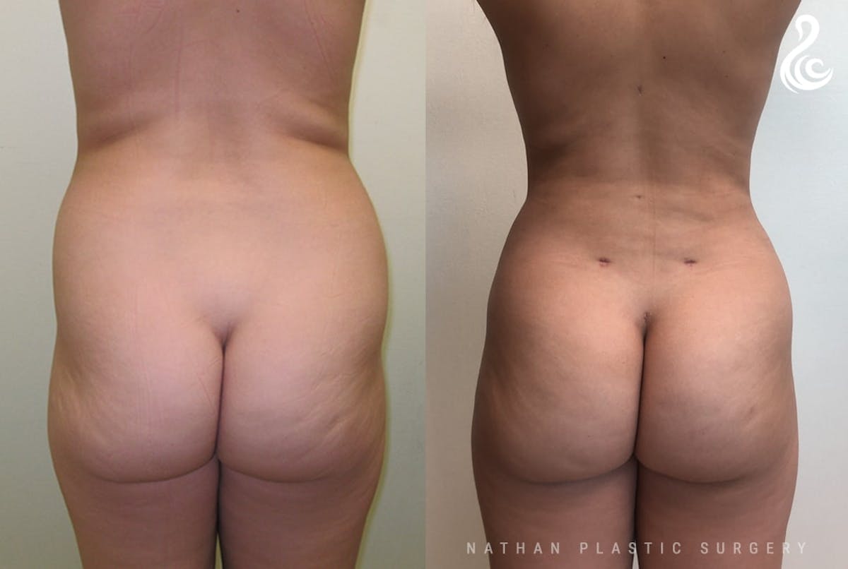 Liposuction Before & After Gallery - Patient 384405 - Image 3