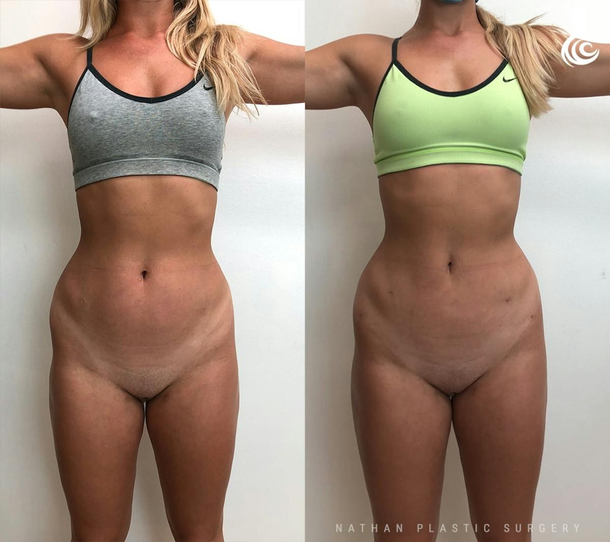Liposuction Before & After Gallery - Patient 315193 - Image 1