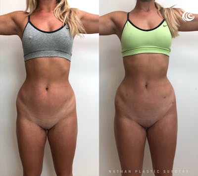 Liposuction Before & After Gallery - Patient 315193 - Image 1