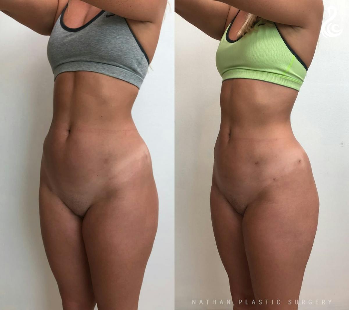 Liposuction Before & After Gallery - Patient 315193 - Image 2