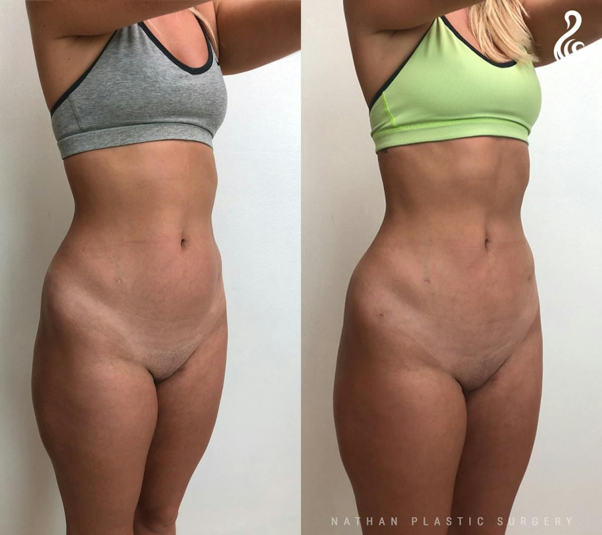 Liposuction Before & After Gallery - Patient 315193 - Image 3