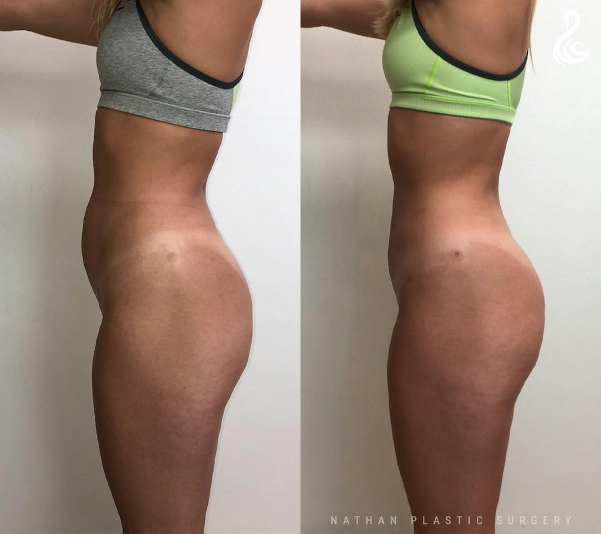 Liposuction Before & After Gallery - Patient 315193 - Image 4
