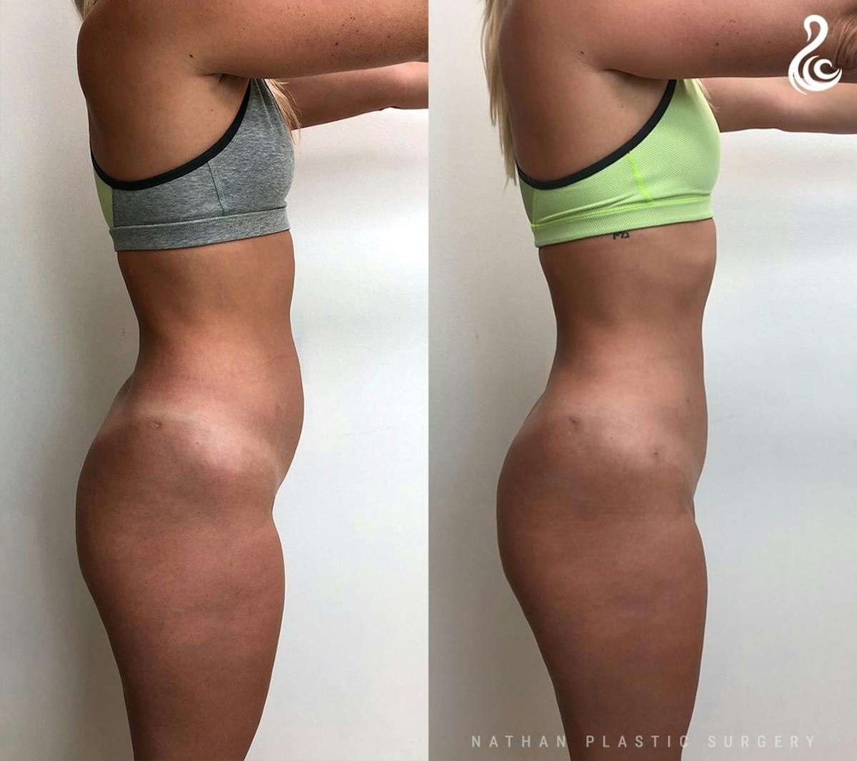 Liposuction Before & After Gallery - Patient 315193 - Image 5