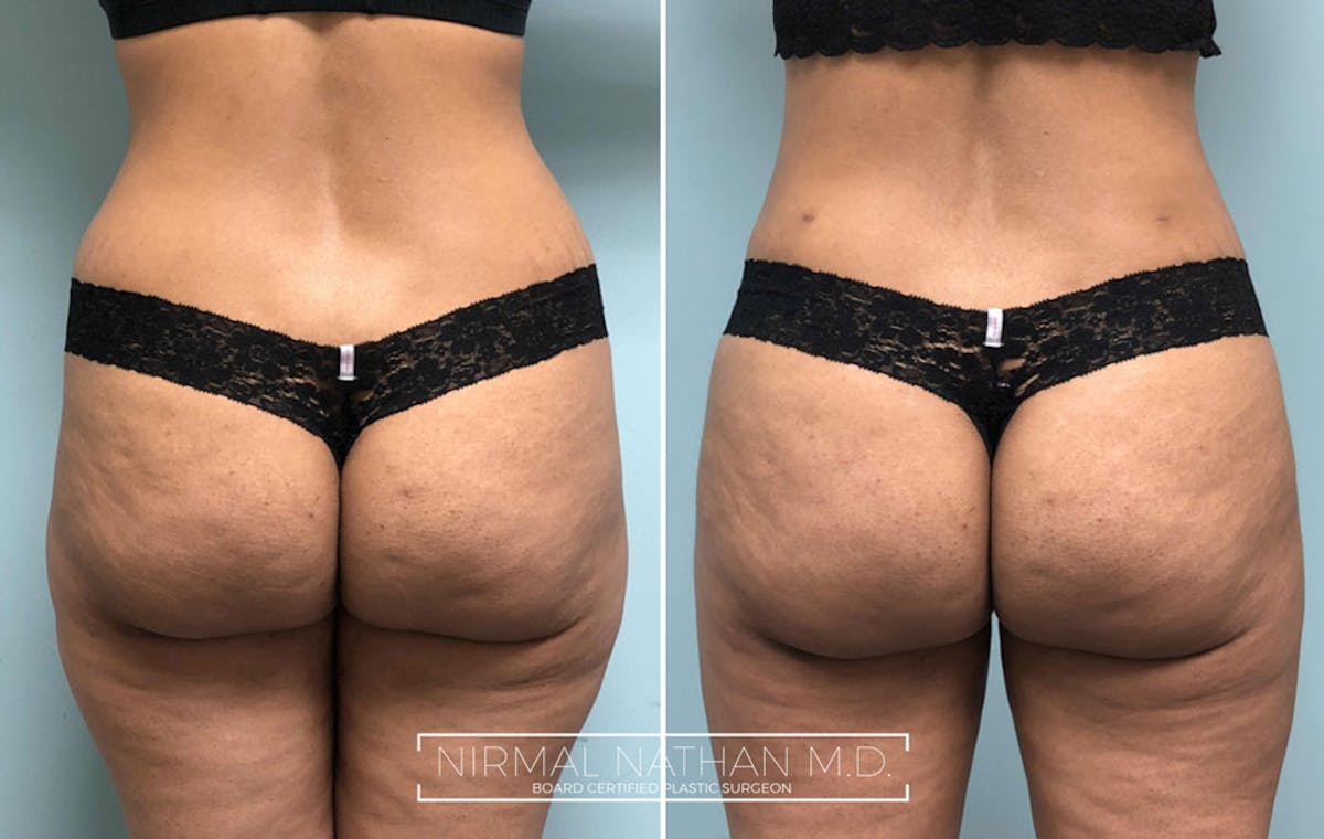 Liposuction Before & After Gallery - Patient 394971 - Image 2