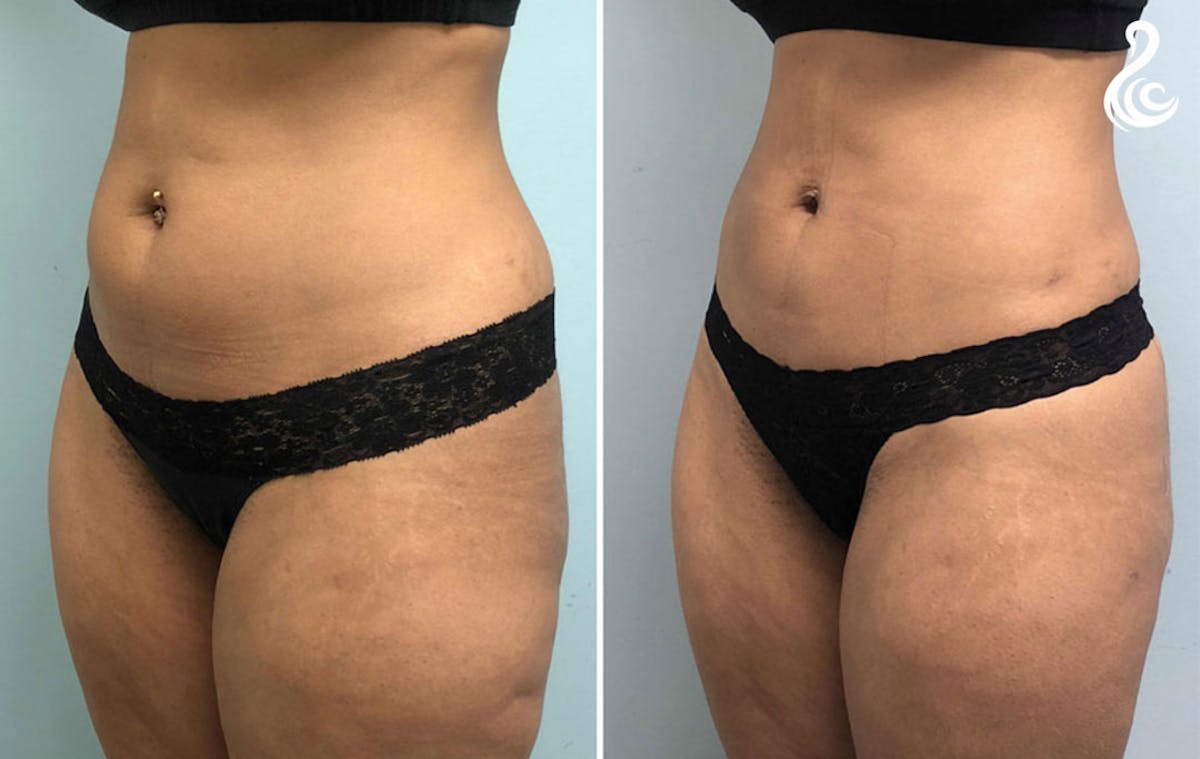 Liposuction Before & After Gallery - Patient 394971 - Image 3