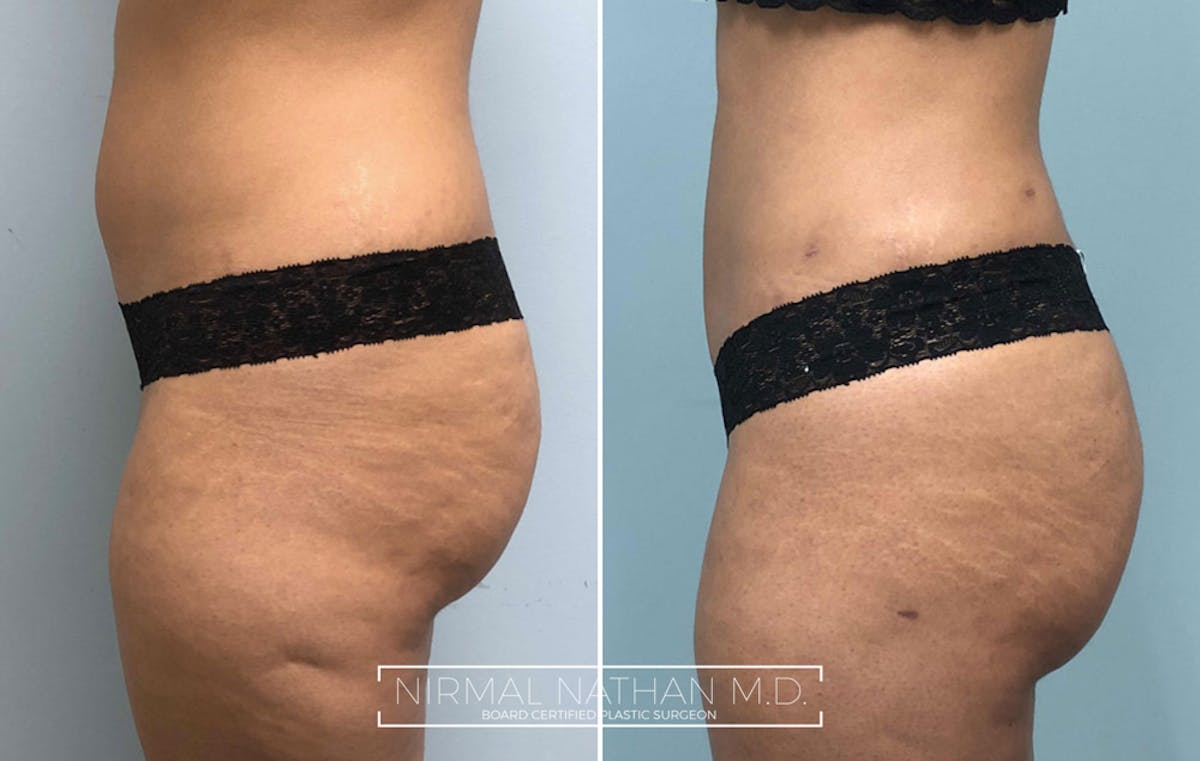 Liposuction Before & After Gallery - Patient 394971 - Image 4