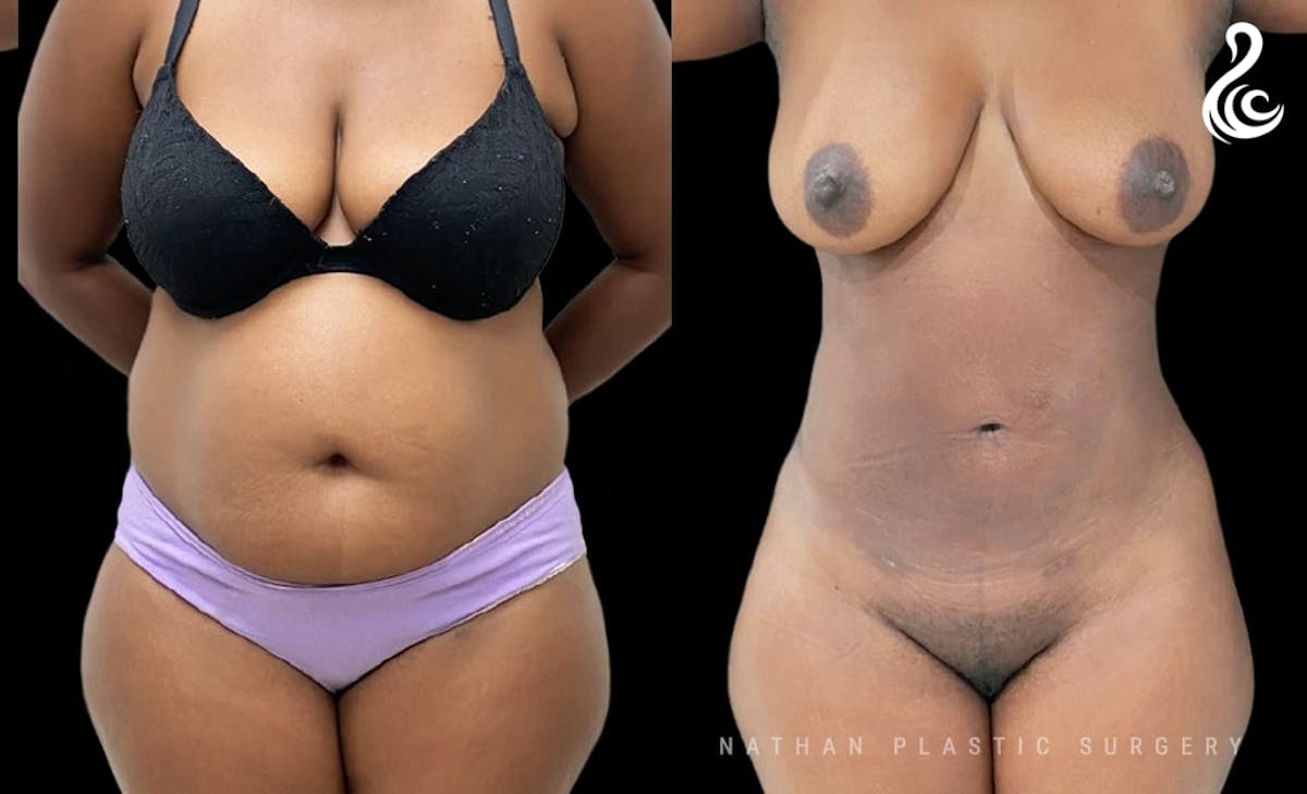 Liposuction Before & After Gallery - Patient 479766 - Image 1