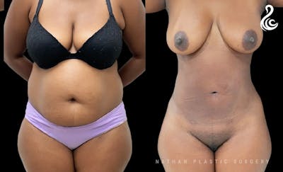 Liposuction Before & After Gallery - Patient 479766 - Image 1