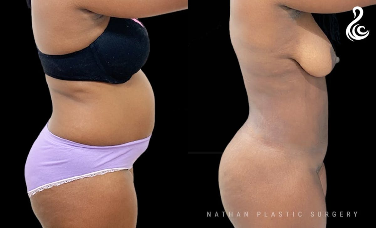 Liposuction Before & After Gallery - Patient 479766 - Image 2
