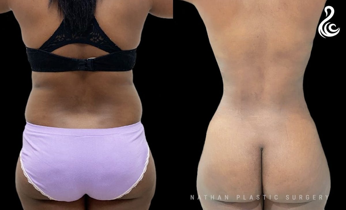 Liposuction Before & After Gallery - Patient 479766 - Image 3