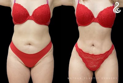 Liposuction Before & After Gallery - Patient 103662 - Image 1