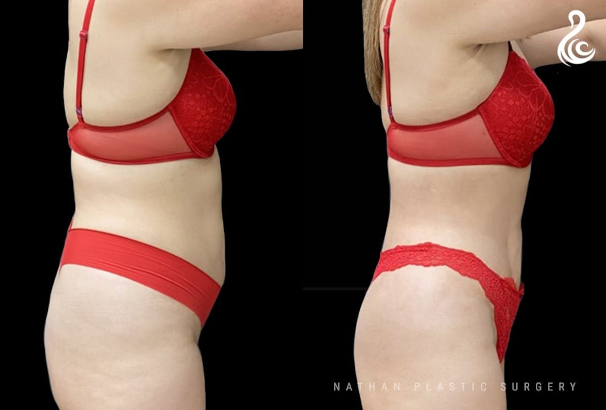 Liposuction Before & After Gallery - Patient 103662 - Image 2