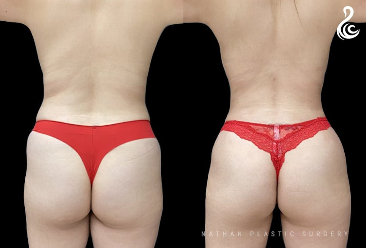 Liposuction Before & After Gallery - Patient 103662 - Image 3