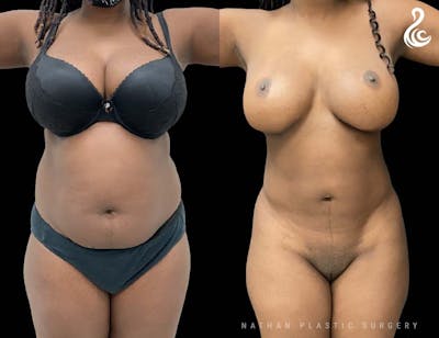 Liposuction Before & After Gallery - Patient 316709 - Image 1