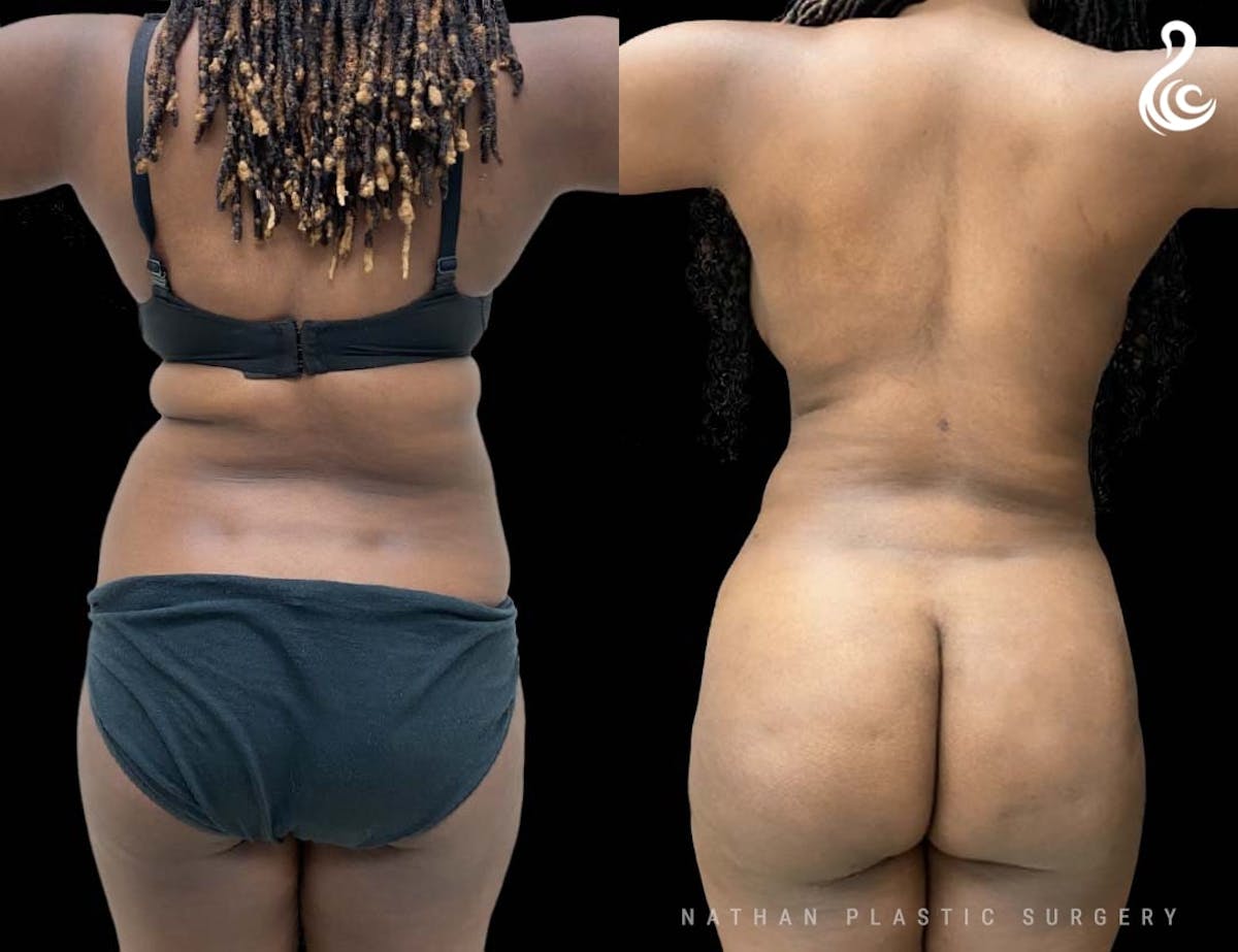 Liposuction Before & After Gallery - Patient 316709 - Image 2