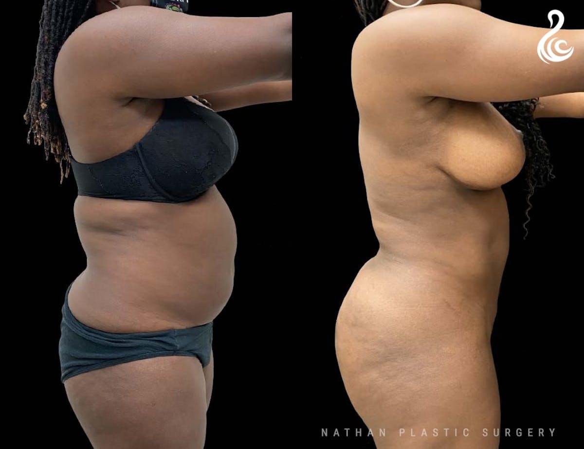 Liposuction Before & After Gallery - Patient 316709 - Image 3