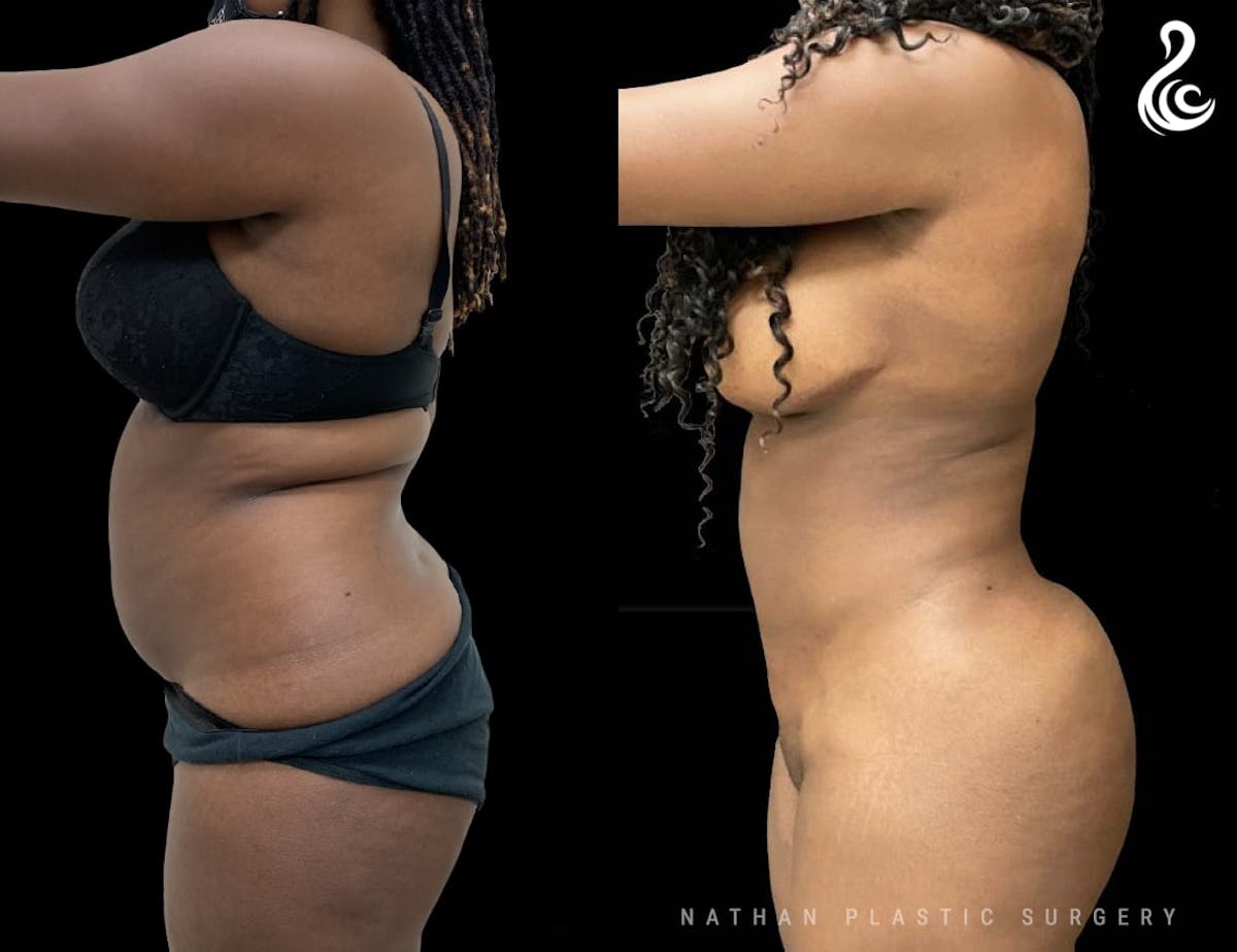 Liposuction Before & After Gallery - Patient 316709 - Image 4