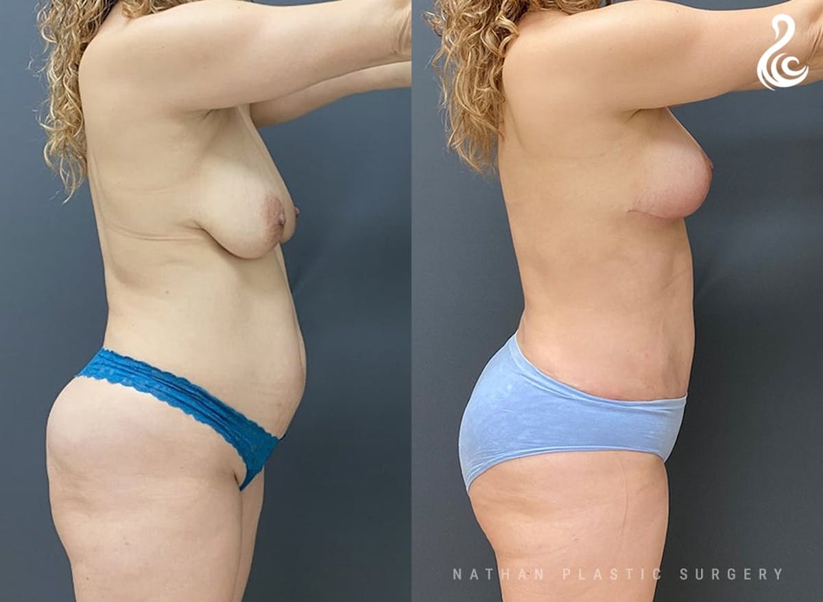 Liposuction Before & After Gallery - Patient 210251 - Image 2