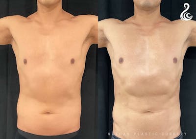 Liposuction Before & After Gallery - Patient 199335 - Image 1