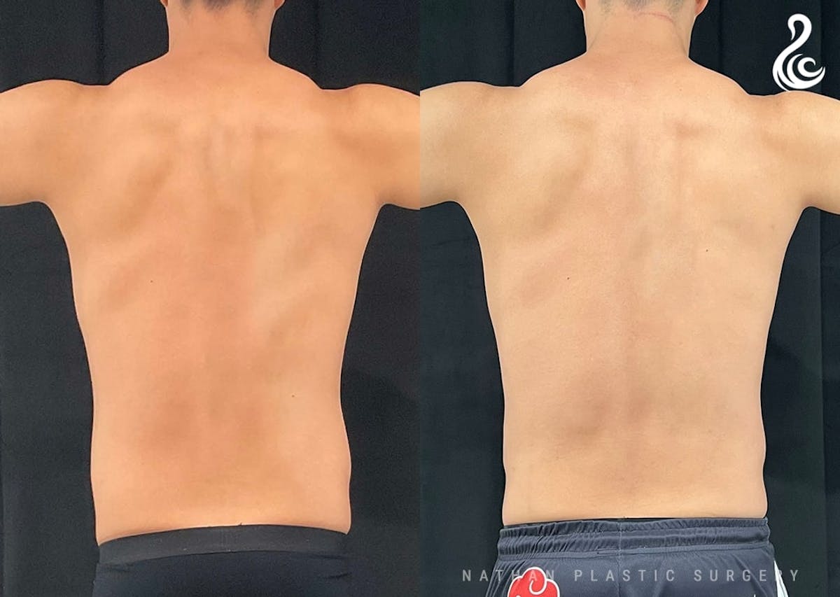 Liposuction Before & After Gallery - Patient 199335 - Image 2