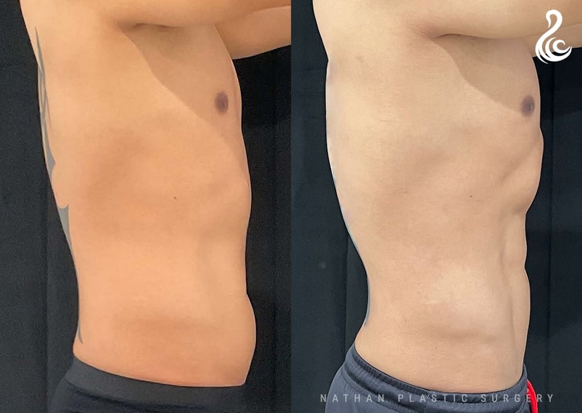 Liposuction Before & After Gallery - Patient 199335 - Image 3