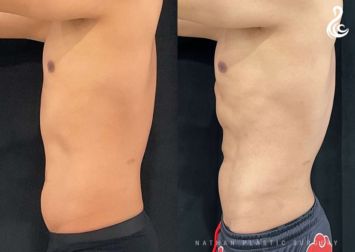 Liposuction Before & After Gallery - Patient 199335 - Image 4