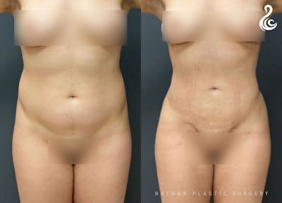 Liposuction Before & After Gallery - Patient 137317 - Image 1