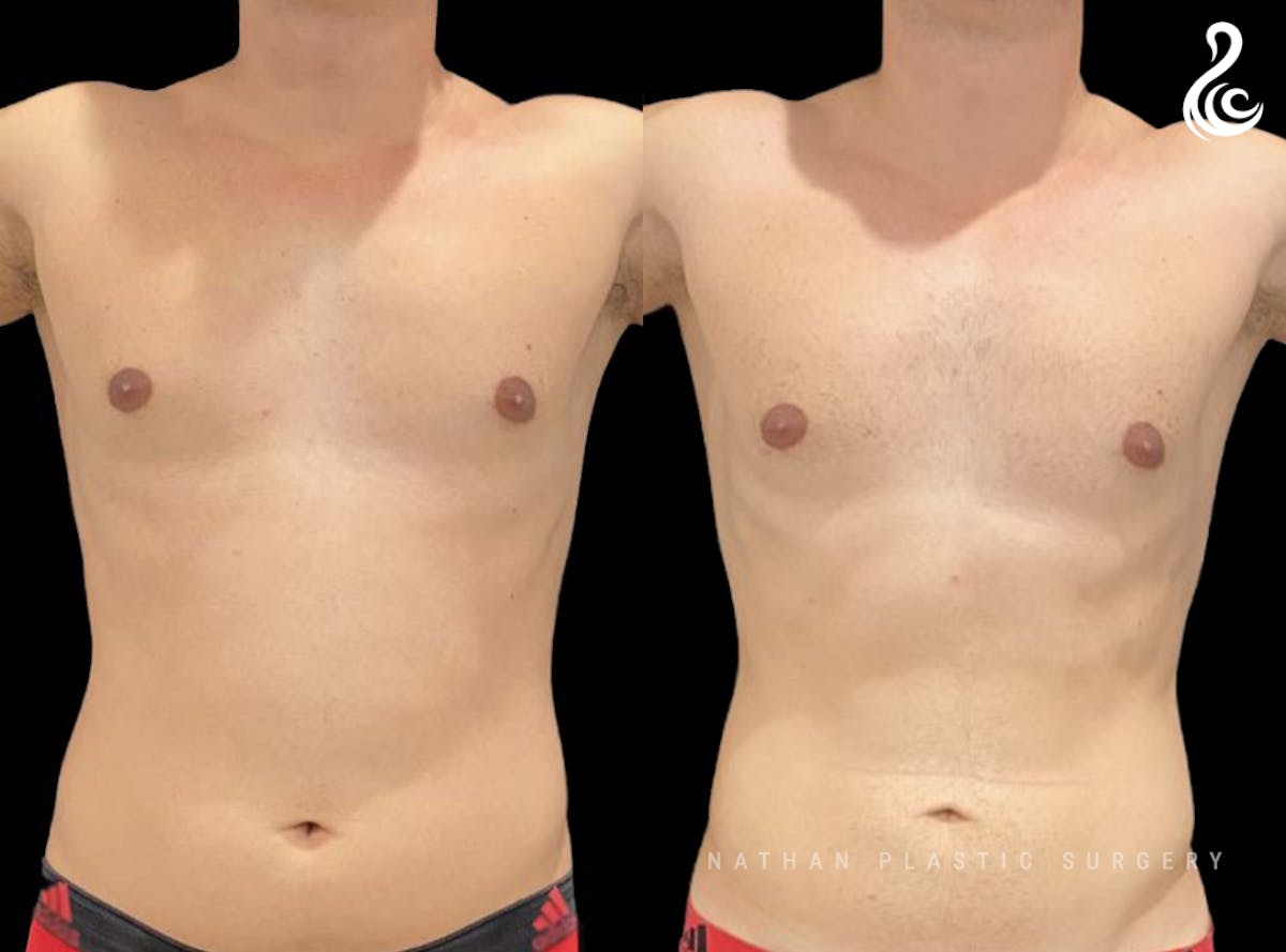 Male Liposuction Before & After Gallery - Patient 416671 - Image 1