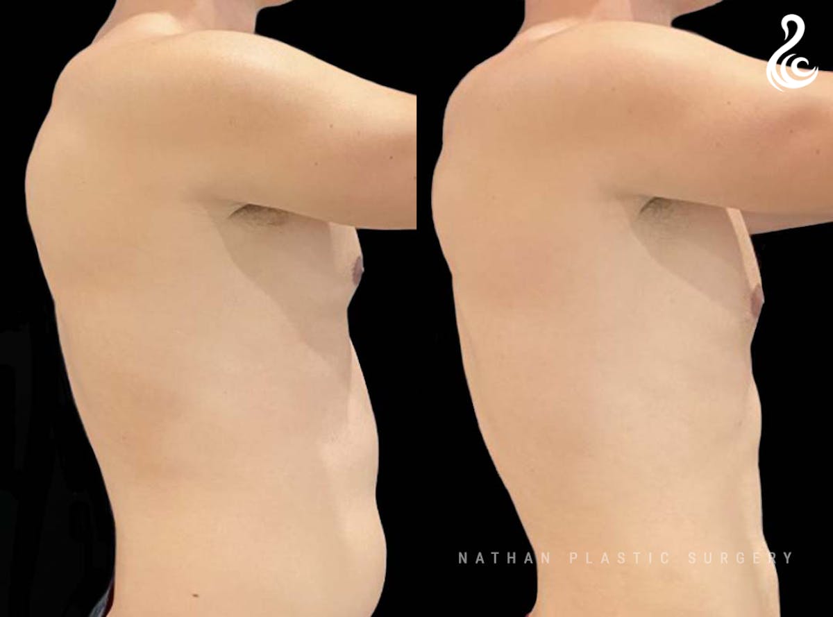 Male Liposuction Before & After Gallery - Patient 416671 - Image 2