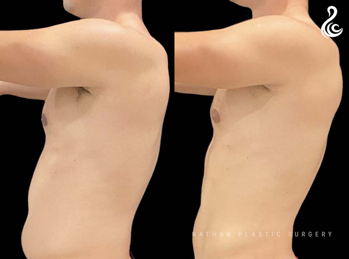 Male Liposuction Before & After Gallery - Patient 416671 - Image 3
