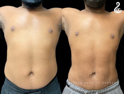 Male Liposuction Before & After Gallery - Patient 231869 - Image 1