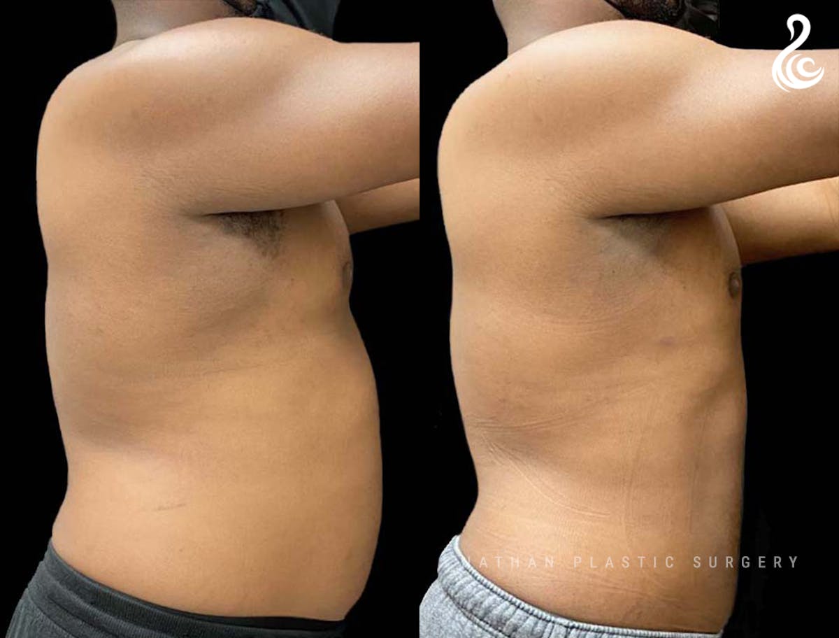 Male Liposuction Before & After Gallery - Patient 231869 - Image 2
